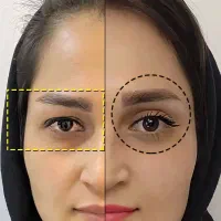 جراحی پف پلک بالا