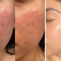 پک رفع جوش و جای جوش