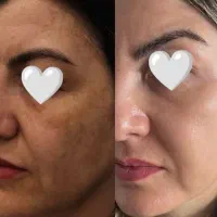 صابون ضدلک وکرم مکمل