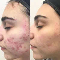 رفع جوش التهابی فقط با سه میلیون و سیصد و نود