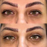 عمل پلک با بخیه لیزری،لیفت دایرکت ابرو،ساکشن غبغب