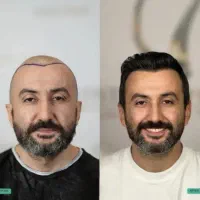 کاشت مو با روش نوین و نزدیک ترین قیمت به بودجه شما