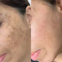تضمینی لکهاتو درمان کن