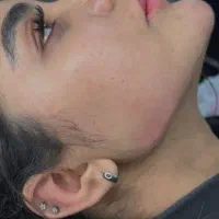 تزریق فیلر لب زاویه سازی چانه گونه خط لبخند