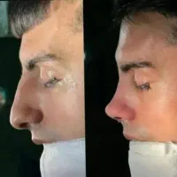 جراحی زیبایی بینی ارزان و آس