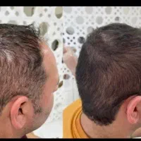 خداحافظی با کم پشتی