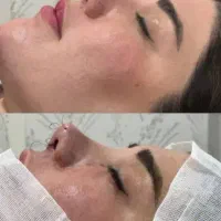 تخفیف ویژه عمل بینی اهواز 30