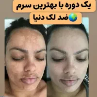 با لک های صورتت خداحافظی کن