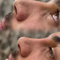 خدمات زیبایی و جوانسازی صورت و بدن ژل بوتاکس فیلر