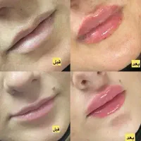 تخفیف ویژه  بوتاکس و فیلر