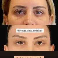 جراحی زیبایی بلفاروپلاستی،مینی لیفت صورت