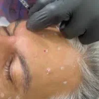 ژل وبوتاکس و فیلر بادی