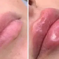هیپ دیپ و فیلربادی قزوین