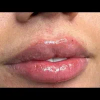 ریموو انواع تاتوهای قدیمی با لیزر