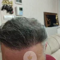 جشنواره‌کاشت‌مو(VIP)۲۴تومن کاشت ابرو۱۵(اقساط)