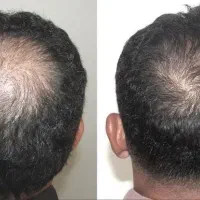 قطع ریزش مو