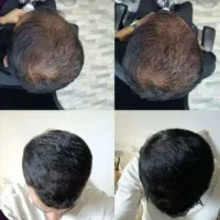 ریزش مو ارثی هم داری ببین