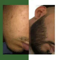 ریشای ریخته شده برمی‌گردن
