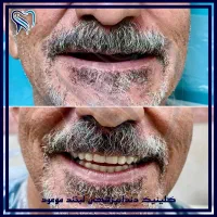 جشنواره ایمپلنت اقساطی دندانپزشکی