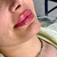 ژل،بوتاکس،رفع تیرگی،جوانسازی،ریموتتو درمان لک