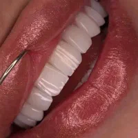 تخفیف ویژه کامپوزیت، لمینت، ایمپلنت قسطی بدون ضامن