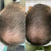مراقبت حرفه ای پوست سر