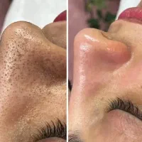 تخفیف ویژه پاکسازی پوست خانم و اقا