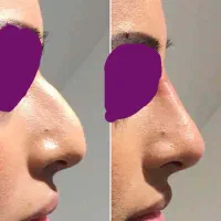 اصلاح فرم بینی با متد انحصاری برزیلی