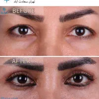 بلفاروپلاستی تخصصی با لیزر