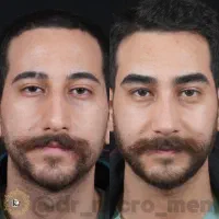 میکروبلیدینگ ابرو آقایان