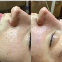 پاکسازی و جوانسازی پوست