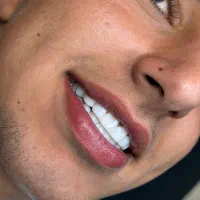 جشنواره تخفیف کامپوزیت دندان ۸ واحد فقط ۱۱/۹۰۰