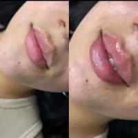 تخفیف ویژه50درصدی فیلروبوتاکس محدوده میدان رازی