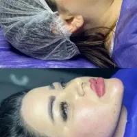 مرکزلیپوساکشن‌ و ساکشن غبغب و زاویه سازی توسط جراح