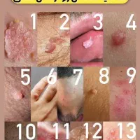 رفع ریشه ای زگیل تناسلی hpv