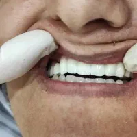 دندانپزشکی، ایمپلنت ، اوردنچر