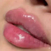 بوتاکس تخصصی و فول فیس درطبرسی شمالی