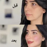 ژل /بوتاکس /سابسیژن در مشهد