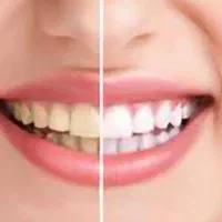 لمینت وی نا KTL