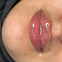 تزریق فیلر و بوتاکس