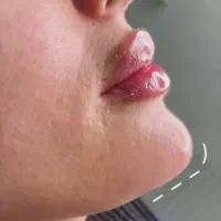 تخفیف ویژه ژل و بوتاکس