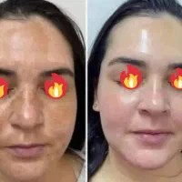قوی ترین سفید کننده و ضدلک 10 کاره بیوممتیک