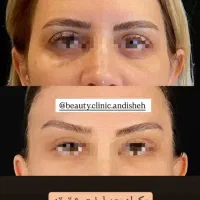 جراحی زیبایی بلفاروپلاستی،مینی لیفت صورت