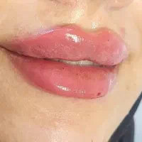 تزریق ژل و بوتاکس و لاغری تضمینی
