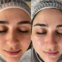 پاکسازی و جوانسازی پوست