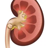 دفع سنگ کلیه بین 7تا 15 روز