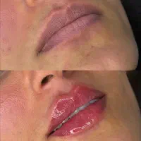 فیلر بوتاکس