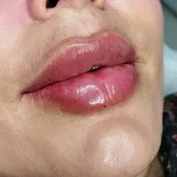 ژل و بوتاکس