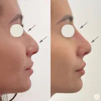 رینو بینی بدون جراحی جمعکردن پره قوزافتادگی انحراف
