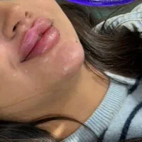 تزریق ژل لب بوتاکس فیلر مزوژل جوانساز gold.skiin